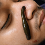 Understanding Jalaukavacharana: The Therapeutic Science Behind Leech Therapy in Ayurveda
