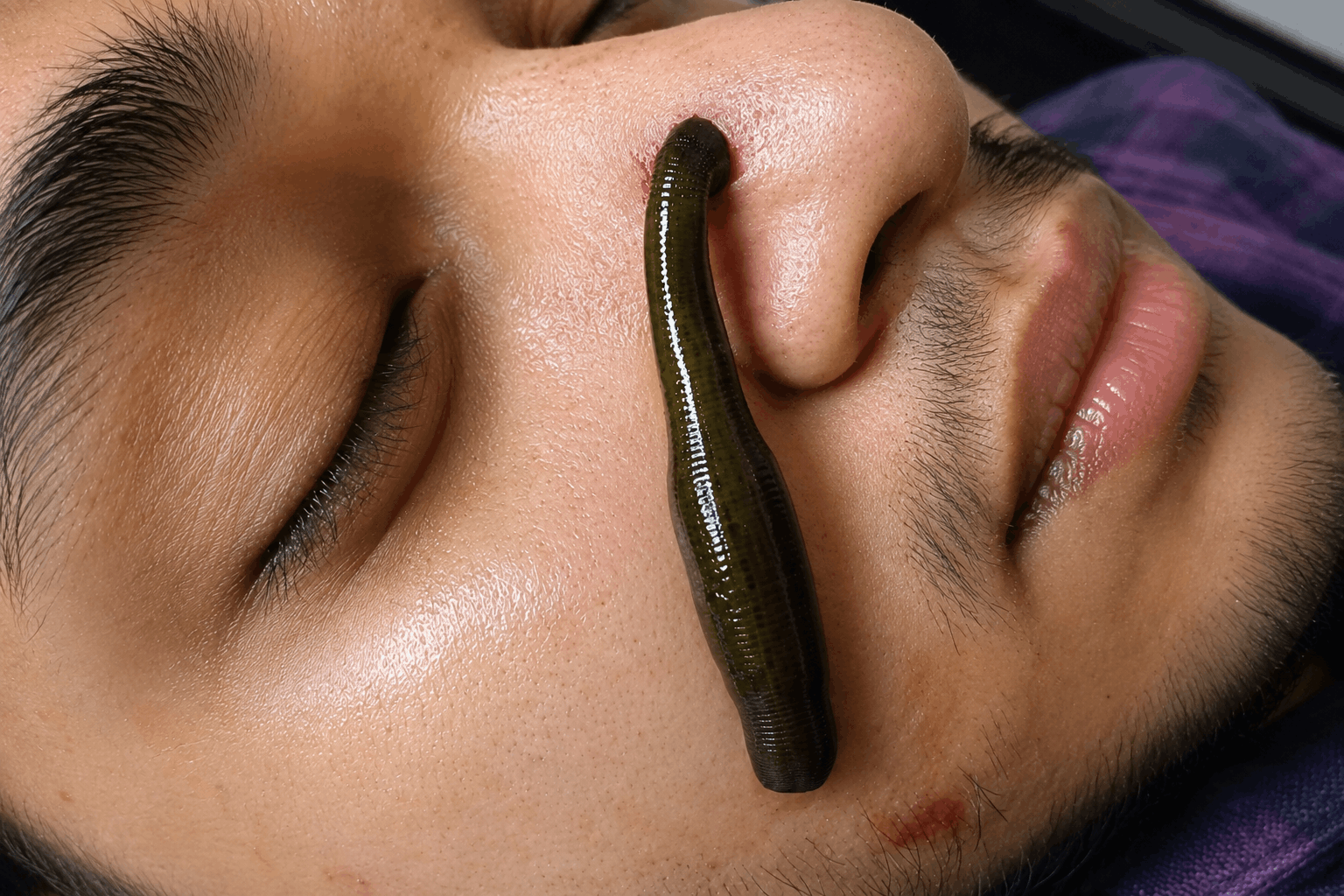 Understanding Jalaukavacharana: The Therapeutic Science Behind Leech Therapy in Ayurveda